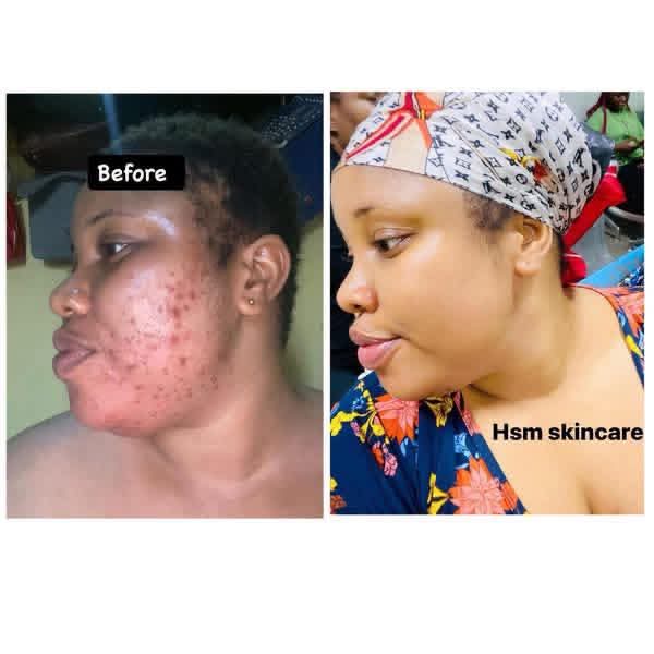HSM Facial Kit for Hormonal Acne, Pimples & Hyperpigmentation - Image 3